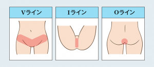 Vラインの脱毛の範囲